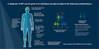 Revised Diagnostic Criteria For Neurofibromatosis Type 1 And Legius  Syndrome: An International Consensus Recommendation | Genetics In Medicine