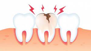 5 Obat Sakit Gigi Berlubang Aman Konsumsi dan Penyebabnya