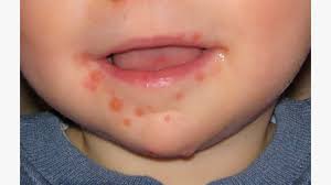 Image result for Hand foot and mouth disease HFMD roof of mouth