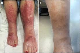 Image result for Stasis Dermatitis