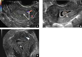 Nov 22, 2019 · complete pelvic ultrasound (upeltv) this is a complete pelvic ultrasound exam, including transabdominal and transvaginal. 42 Year Old Woman With Abnormal Uterine Bleeding Mdedge Obgyn
