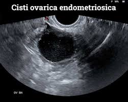 L'endometriosi è una condizione corporea completa in cui cellule simili a quelle dell'endometrio , lo strato di tessuto che. Diagnosi E Cura Dell Endometriosi Seno Clinic