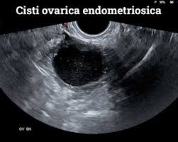 However, it is unclear whether the growth of lesions is independent to estrogen, or if there is a sensitivity to estrogen, or production of estrogen, comes from the lesion itself. Diagnosi E Cura Dell Endometriosi Seno Clinic