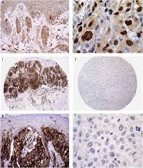 Image result for Spitz Nevus