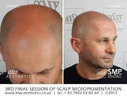 See photos, profile pictures and albums from scalp aesthetics. Scalp Micropigmentation Before After Mw Aesthetics