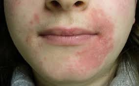 Signs and symptoms of skin which medicine works best for skin allergies? Perioral Dermatitis Cure Signs Risks Everything You Need To Know Skinkraft