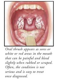 Image result for oral thrush symptoms roof of the mouth