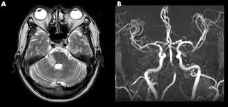 Tinnitus as we call it), is pulsatile, that is oscillating in intensity, another but less likely possiblity is a problem at the jugular foramen (an area in the skull base close to the. Auditory Disturbance As A Prodrome Of Anterior Inferior Cerebellar Artery Infarction Journal Of Neurology Neurosurgery Psychiatry