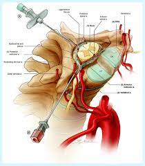 Epidural Steroid Injections An Updated Review On Recent Trends In Safety And Complications Pain Management