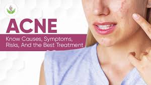 Speak to an attorney now. Acne Know Causes Symptoms Risks And The Best Treatment Blog Care Well Medical Centre