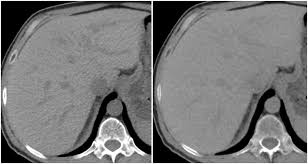 Comparison Of Virtual To True Unenhanced Abdominal Computed Tomography Images Acquired Using Rapid Kv Switching Dual Energy Imaging