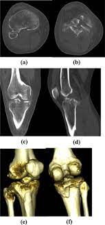 * converts the electrical signal that we get from detectors into a measure of attenuation and thickness (ct numbers). Multi Detector Computed Tomography Assessment Of The Tibial Plateau Fractures Sciencedirect