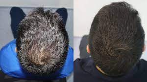 Where the hair is shorter on the crown while bringing more attention to the front of your head, like a quiff. Hair Transplant Result With 2300 Grafts Crown Transplant Receding Hairline Youtube