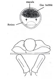 Retinal detachment is a serious eye condition that happens when your retina pulls away from the tissue around it. Instructions Re Post Operative Posturing Following Retinal Surgery Hull University Teaching Hospitals Nhs Trust