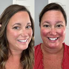 A few people were asking about rosacea, so here is a video made by my  partner in crime Ashley Coote! Love the coverage but how natural it looks!  1 entry into the