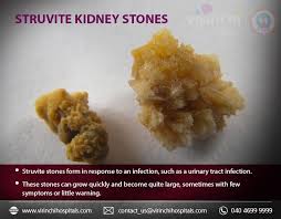 Struvite Kidney Stones With Images Kidney Stones Kidney Urinary Tract Infection