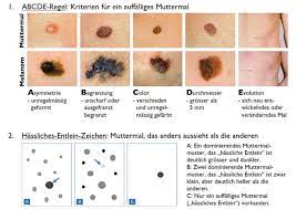 Dermapraxis Luzern Muttermale Und Schwarzer Hautkrebs