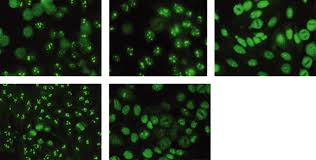Image result for ANA Staining Pattern