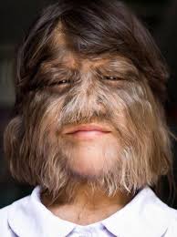 Regardless of age or gender, this disorder can occur to anyone. Girl With Hypertrichosis Also Known As Werewolf Syndrome 9gag