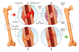I break my views into two types, parent views and child. Strategies To Help Heal Your Broken Bones Direct Orthopedic Care