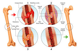 Diagram of human back bones, diagram of the human back bones, human back bones anatomy, human back bones diagram, human back skeleton diagram, bone, diagram of human. Strategies To Help Heal Your Broken Bones Direct Orthopedic Care