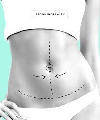 Going Under The Knife Read This First Skin Removal Surgery Tummy Tuck Cost Abdominoplasty