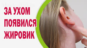 Mi a aparut o umflatura in spatele capului pe partea dreapta aproape de ureche. In Spatele Urechii O Durere De UmflaturÄ Condensare Durere Cand Era PresatÄ Pe Ea