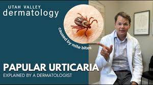 Image result for Papular urticaria