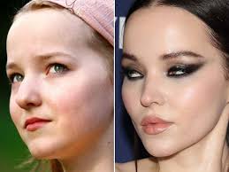 Dove Cameron Plastic Surgery Journey