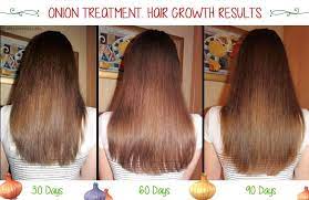 Onion Remedies For Hair Growth Grandma S Advices Hair Regrowth Treatments Onion Juice For Hair Hair Mask For Growth