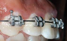 Fortunately, there are a number of different products that can make it easier to clean plaque and food debris from around your teeth and brace brackets. Keeping Braces Clean Kingston Nj
