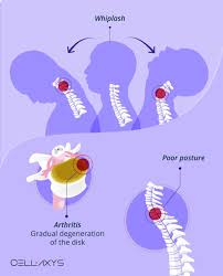 A Stiff Neck A Weak Stomach How Neck Pain Can Cause Nausea Cellaxys