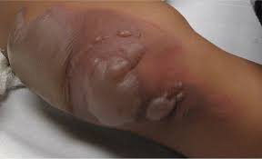 Please share this article with your friends and family. Outpatient Burns Prevention And Care American Family Physician