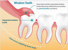 Wisdom tooth removal can be carried out by a dentist or a specialist surgeon working in a hospital. How Do You Make Wisdom Tooth Pain Go Away Complete Dental Care