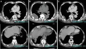 We present a case of pleural sarcomatoid mesothelioma, the rarest type of mesothelioma, with focus in thoracic ct findings and anatomopathological correlation . Remarkable Response To Nivolumab In Sarcomatoid Malignant Pleural Mesothelioma With High Pd L1 Tsubouchi 2020 Respirology Case Reports Wiley Online Library