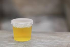 Tampilan normal air seni dari tubuh yang sehat dan bebas penyakit adalah tampak bening, jernih, dan berwarna. Terapi Urine Dengan Minum Air Kencing Benarkah Efektif
