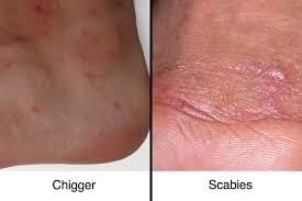 Image result for scabies human bites