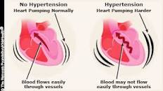 Image result for hypertension