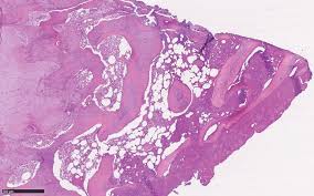 Osteosarcoma is the most common type of cancer that begins in you or your teenager's bones, usually in the arms or legs. Osteosarcoma Of The Jaw Classification Diagnosis And Treatment Intechopen