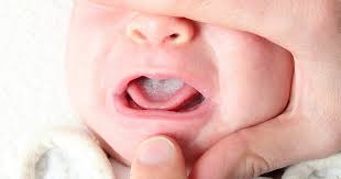 Pertama , memohon keberkahan untuk si anak. Salutan Putih Pada Lidah Kanak Kanak Adalah Penyebabnya Kenapa Ada Salutan Putih Pada Lidah Bayi Baru Lahir Selepas Setahun