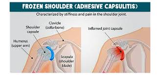 Image result for Shoulder Injection