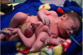 Iraqi Birth Defects Worse Than Hiroshima Africanamerica Org