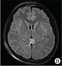 We did not find results for: Diffuse Axonal Injury A Devastating Pathology Intechopen