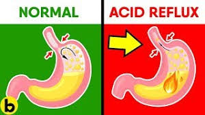 How Baking Soda Can Help With Acid Reflux Heartburn Youtube