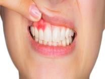 Gum Disease Treatment in Wagholi, Pune product image