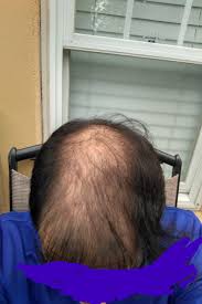 3500 Fue Grafts Scheduled With Dr Bhatti Darling Buds On 18th March 2019 Hair Transplant Experiences And Surgeon Reviews Hair Restoration Network Community For And By Hair Loss Patients