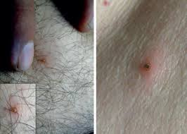 Scielo Brasil Skin Manifestations Of Tick Bites In Humans Skin Manifestations Of Tick Bites In Humans
