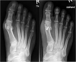 Wählen sie schuhe mit einem guten fussbett und breitem zehenfach. Vorfuss Hallux Valgus Hallux Rigidus Kleinzehenfehlstellung Grosstes Kommunales Krankenhaus In Nrw