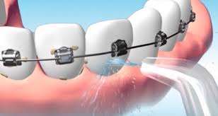 Brush twice a day for 2 minutes, making sure to brush all surfaces of the teeth and using a toothpaste recommended above. How To Properly Brush And Floss Your Teeth With Braces Smileon Orthodontics Cedar Park Tx Invisalign