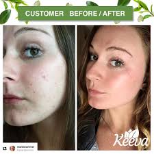 Here is what she said scar remedies natural remedies cold remedies health remedies tea tree oil for acne acne face. Amazon Com Acne Treatment Cream With Secret Tea Tree Oil Formula Perfect For Acne Scar Removal Fighting Breakouts Spots Cystic Acne See Results In Days Without Dry Skin Beauty